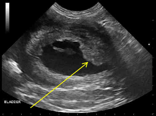 Bladder Cancer Ultrasound