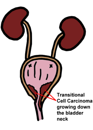 Urinary tract with a transitional cell carcinoma growing in the bladder neck and down the urethra.