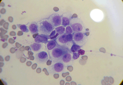 In this cell sample, the small round cells are red blood cells. The large blue-purple cells are TVT cells.