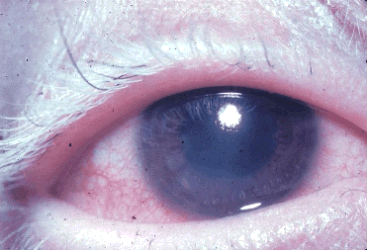 Human eye showing VKH syndrome. 