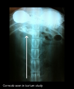 corn cob in barium study graphic